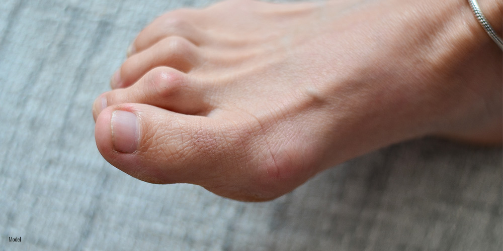 Minimal Incision Hammertoe Surgery in NYC